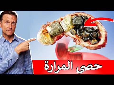 العلامة الأولى التي تخبرك بوجود حصى المرارة في 80% من الحالات وكيف تذيبها وتمنع حدوثها مرى أخرى