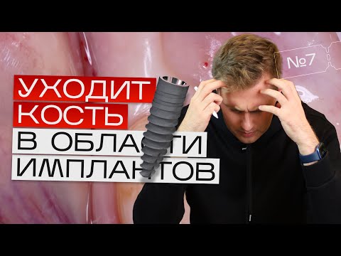 Должна ли уходить кость в области имплантов? Краевая резорбция. Игорь Налиткин