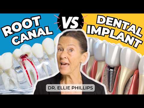 Root Canals vs Dental Implants: Which is Better for You?