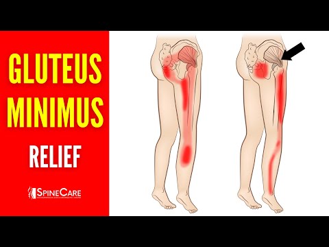 How to INSTANTLY Relieve Gluteus Minimus Pain