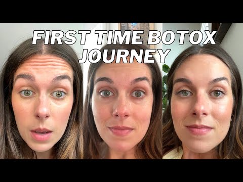 GETTING BOTOX FOR THE FIRST TIME! Why I did it, my experience and results