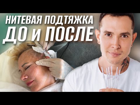 Подтяжка нитями ДО и ПОСЛЕ | Процесс установки нитей #мезонити