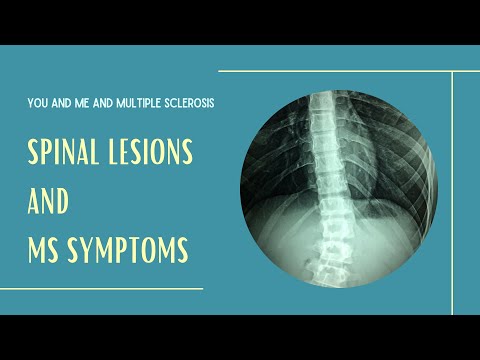 Spinal cord lesions and MS: Symptoms and prognosis