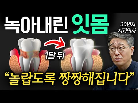 내려앉고 피가 나는 잇몸을 위한 가장 확실한 치료 방법 (박창진 원장 2부)