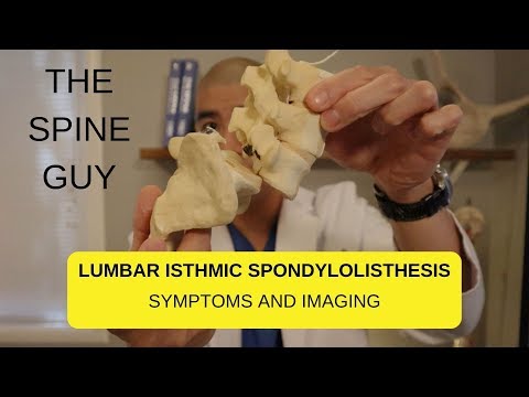 Lumbar Isthmic Spondylolisthesis - Part 1 - What is it?