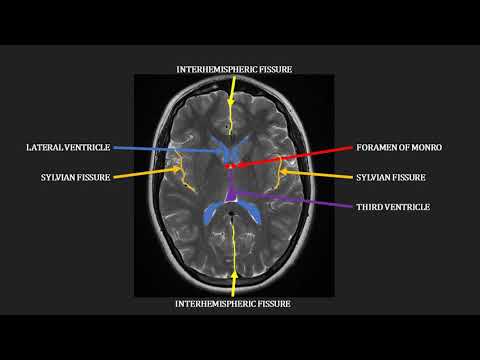 Introduction to MRI of the brain