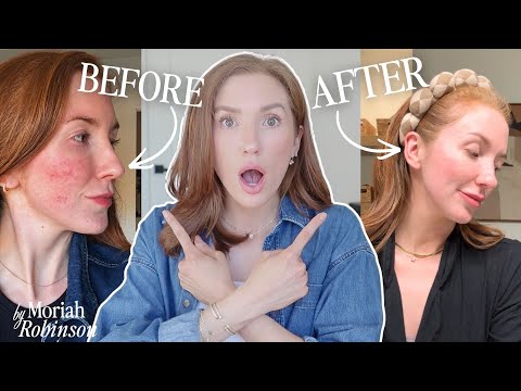 If you have Rosacea Acne Prone Skin: WATCH THIS!! | How I Cleared Acne Rosacea WITHOUT Medication!!
