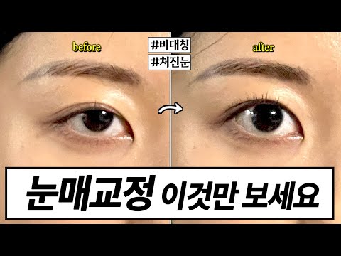 이마로 눈뜨는 사람 모두 집합! : 물리치료사가 알려주는 비대칭 눈매 교정 , 눈매교정브이로그 , 안검하수 , 비대칭눈교정