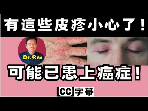 皮肌炎和腫瘤有關,及早認識疲肌炎的皮膚變化能拯救生命dermatomyositis: a rare disease which may associate with internal cancer