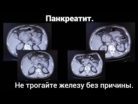Pancreatitis. Don't touch the gland without a reason.