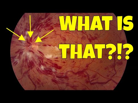 Retinal Pathologies: USMLE Step 1