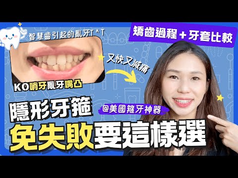 【箍牙】隱適美以外的美國隱形牙套大牌🦷快30%又減痛‼️改善哨牙亂牙嘴突😁智慧齒:諮詢➜剝牙➜產品開箱➜矯齒過程➜心得~隱適美以外的選擇🤑|隱形牙箍|透明牙套|牙齒矯正|Sure Smile