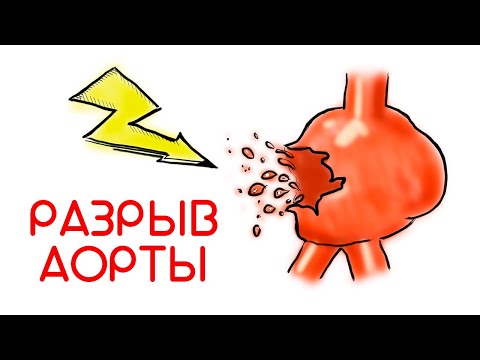 Разрыв аорты = смерть? // Доктор Ху