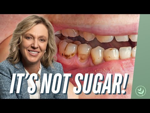 What Causes Cavities? Why Most Dentists Get It Wrong