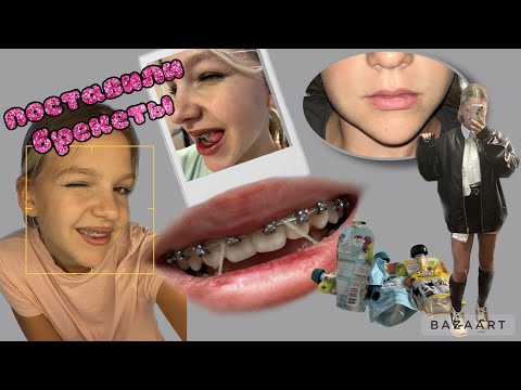 *ставлю БРЕКЕТЫ* ❤️ недельный влог+ удаление зуба мудрости*