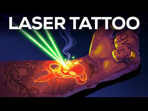 Tattoo Removal Is Insane