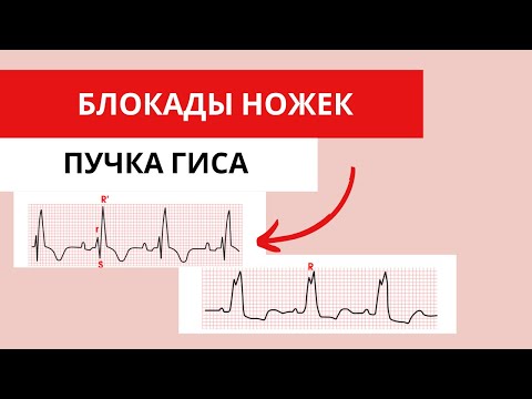 Блокады ножек пучка Гиса. Как различать на ЭКГ?