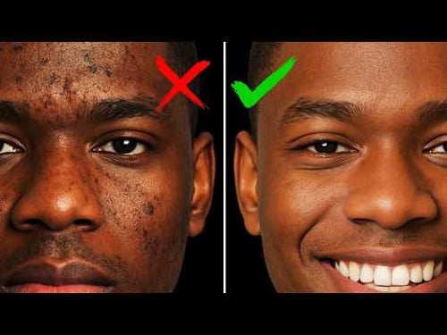How to fix Hyperpigmentation (Science Based)