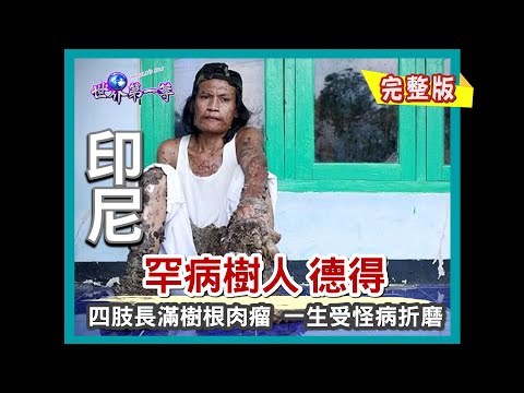 【印尼】罕病樹人—德得四肢佈滿樹根肉瘤 受怪病折磨的一生(世界最髒河流芝塔龍河/罕病奇人馬戲團)|《世界第一等》229集小馬完整版