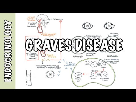 Grave's Disease