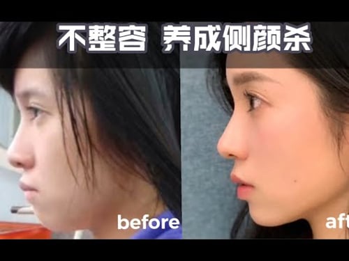How to solve MANDIBULAR RETRUSION without plastic surgery?【Winnie】