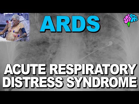 What is ARDS? Acute Respiratory Distress Syndrome