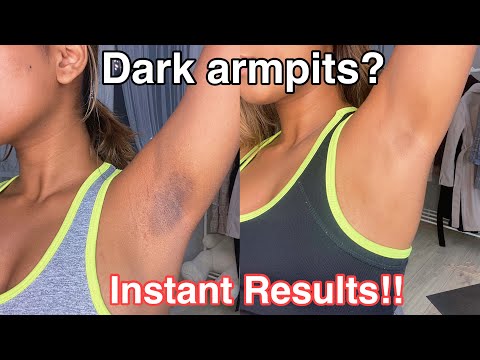 How To Get Rid Of Dark Armpits INSTANTLY! 100% works