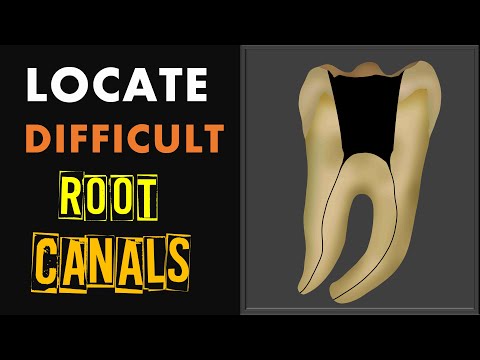 How to locate difficult root canals