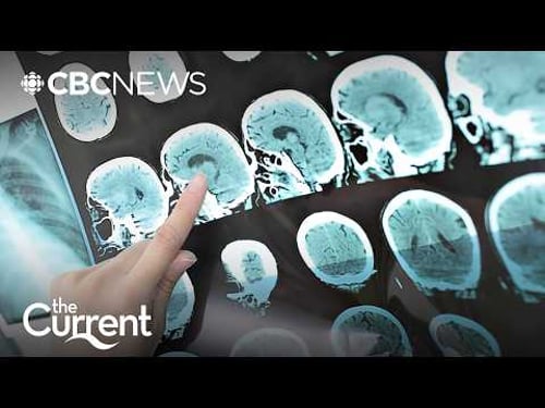 Why are more women diagnosed with Alzheimer’s than men? | The Current