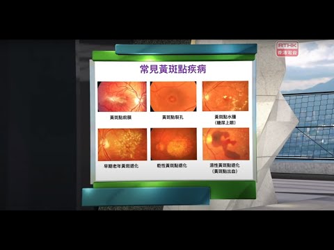 中大眼科 x 精靈一點:陳理佳醫生簡介六大黃斑問題