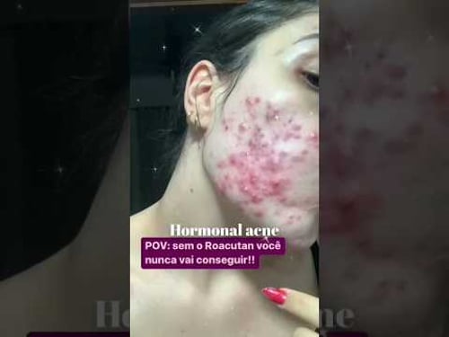 I Beat Hormonal Acne in 3 Easy Steps #acnetreat #glowup #glowuptips #acne #shorts #shortvideo #short