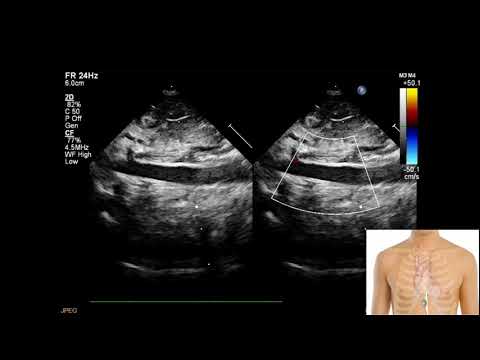 Протокол ЭхоКГ у детей субкостальное окно (рус.)