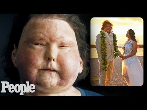 I Survived a Face Transplant — Then Met the Love of My Life | PEOPLE
