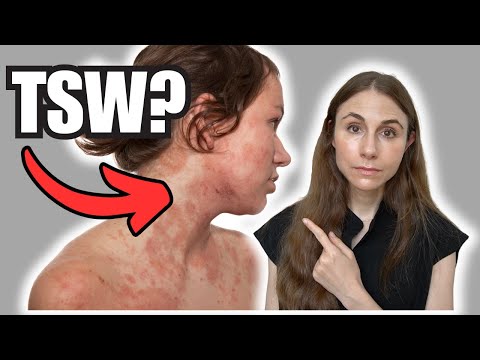 Topical Steroid Withdrawal: What You Need to Know | Dermatologist Explains TSW
