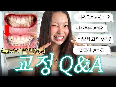 Real review after 6 months of braces treatment..😬 Price, face shape change, braces tips, Q&A🦷