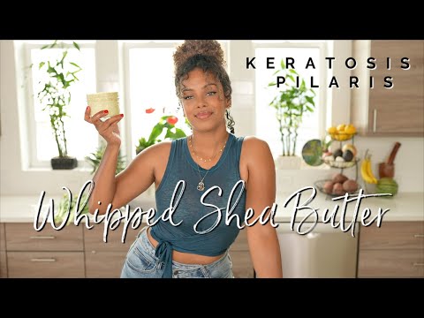 Whipped Shea Butter {3 Ingredients} for Dry, Acne, Scars, Eczema, Pregnancy & Keratosis Pilaris๐