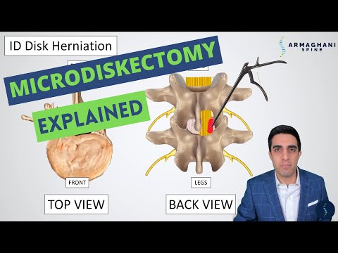 Microdiskectomy: Anatomy, Step by Step Procedure, Risks, Recovery, and Restrictions