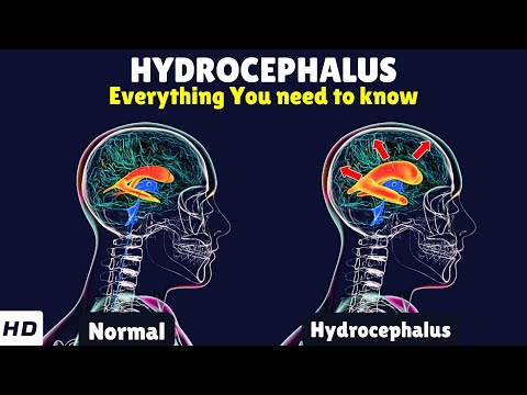 Hydrocephalus – Causes, Signs and Symptoms, Diagnosis & Treatment