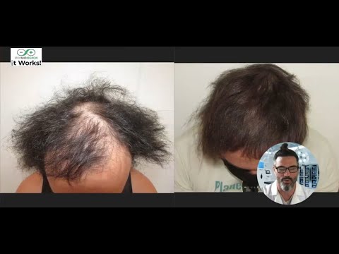 Genetic + Stress Hair Loss Solved: 34-Year-Old Musician’s Case Study | Dr Ray Nettles Q&A