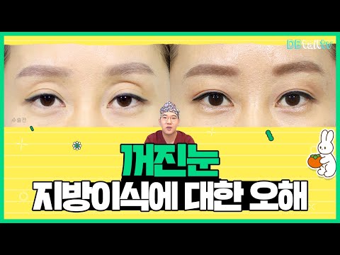 꺼진눈 지방이식에 대한 오해