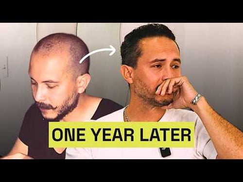 How a Hair Transplant Changed My Life | My Transformation