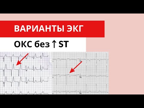 Варианты ЭКГ ОКС без подъема сегмента ST.