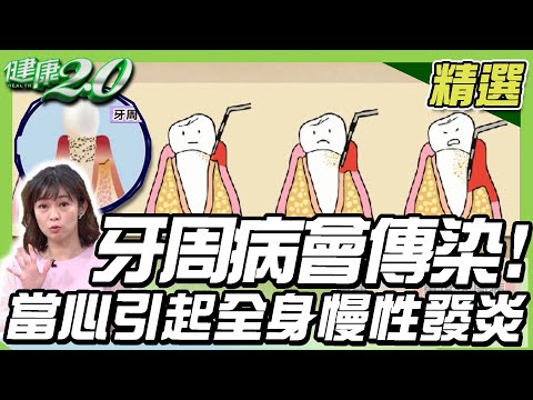 牙周病會傳染!當心會引起全身慢性發炎?牽一齒動全身 傷身又傷財【健康2.0精選】