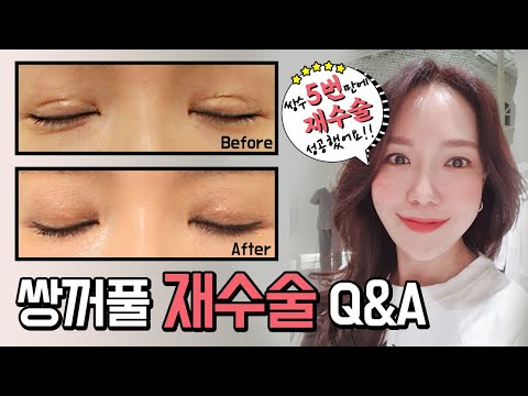 Double eyelid revision surgery 5 times! How to avoid failure with revision surgery using the Doub...