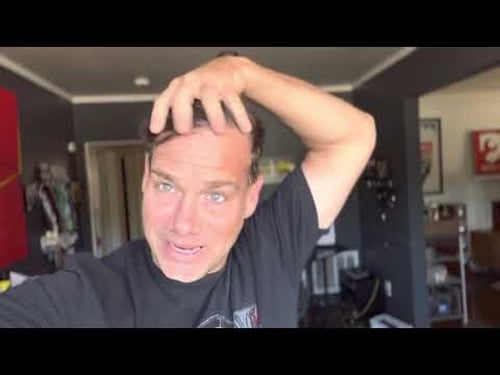 HAIR TRANSPLANT in Turkey. 1 year results.