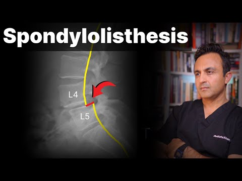Spondylolisthesis: Is Surgery Necessary?