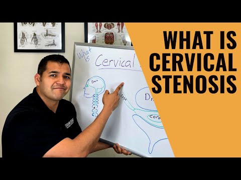 What Is Cervical Stenosis?
