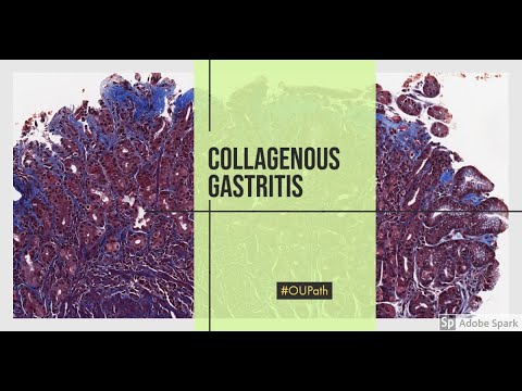 Collagenous gastritis