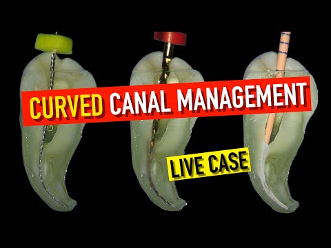 ✅ How to Master a 90° Curved Root Canal – Step-by-Step Guide for Success!