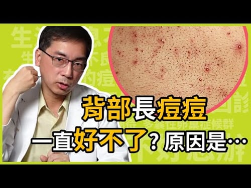 為什麼背部長痘痘,會一直治不好?怎麼治療才不會色素沉澱?治療背部痘痘的關鍵原因,醫美里長一次告訴你!
